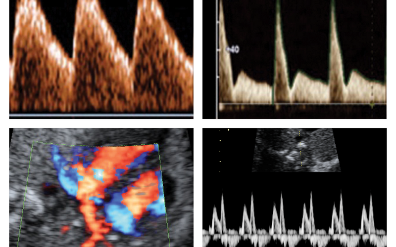 Ultralydbilder som viser normal spektraldopplerkurve av arteria umbilikalis, patologisk kurve av arteria uterina, normal mitralklaff og fargedoppler av pulmonalvener (Foto: Senter for fostermedisin, St. Olavs Hospital)