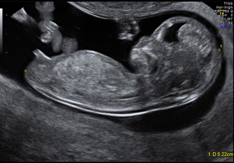 Ultralydbilder som viser foster i svangerskapsuke 11 + 6 dager.